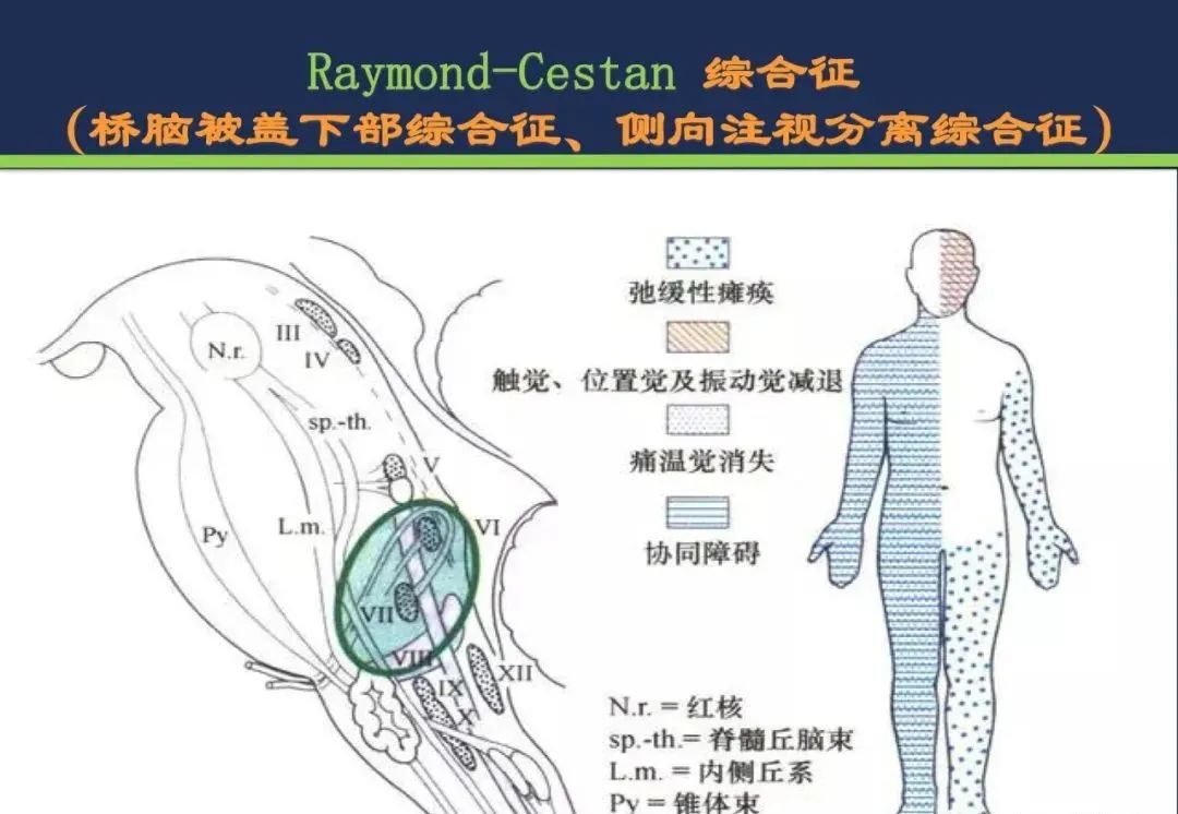 从梗死部位推测责任血管：脑血管解剖-141