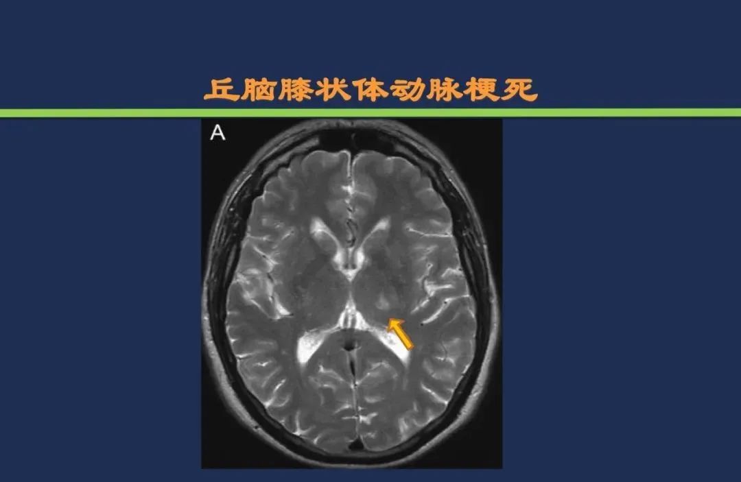 从梗死部位推测责任血管：脑血管解剖-121