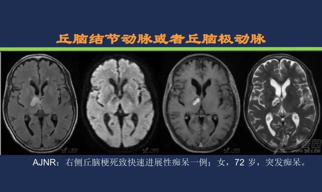 从梗死部位推测责任血管：脑血管解剖-116