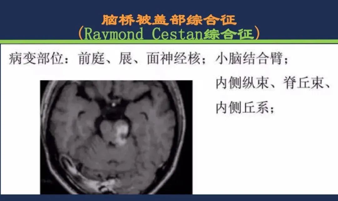 从梗死部位推测责任血管：脑血管解剖-143
