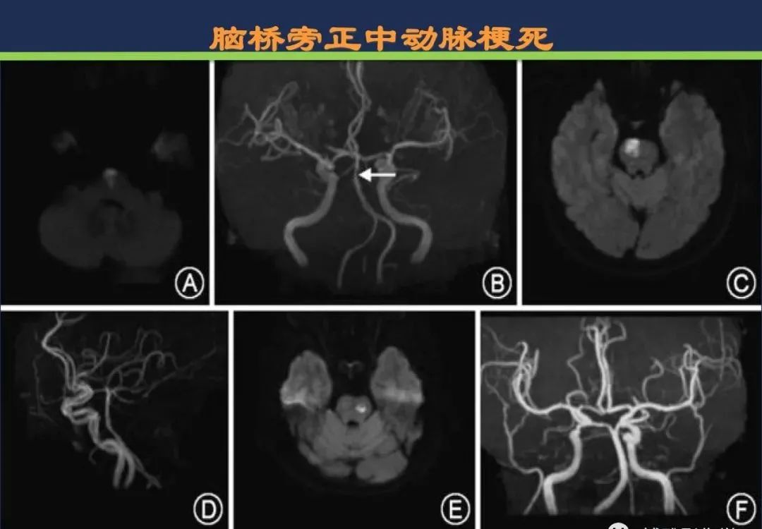 从梗死部位推测责任血管：脑血管解剖-137