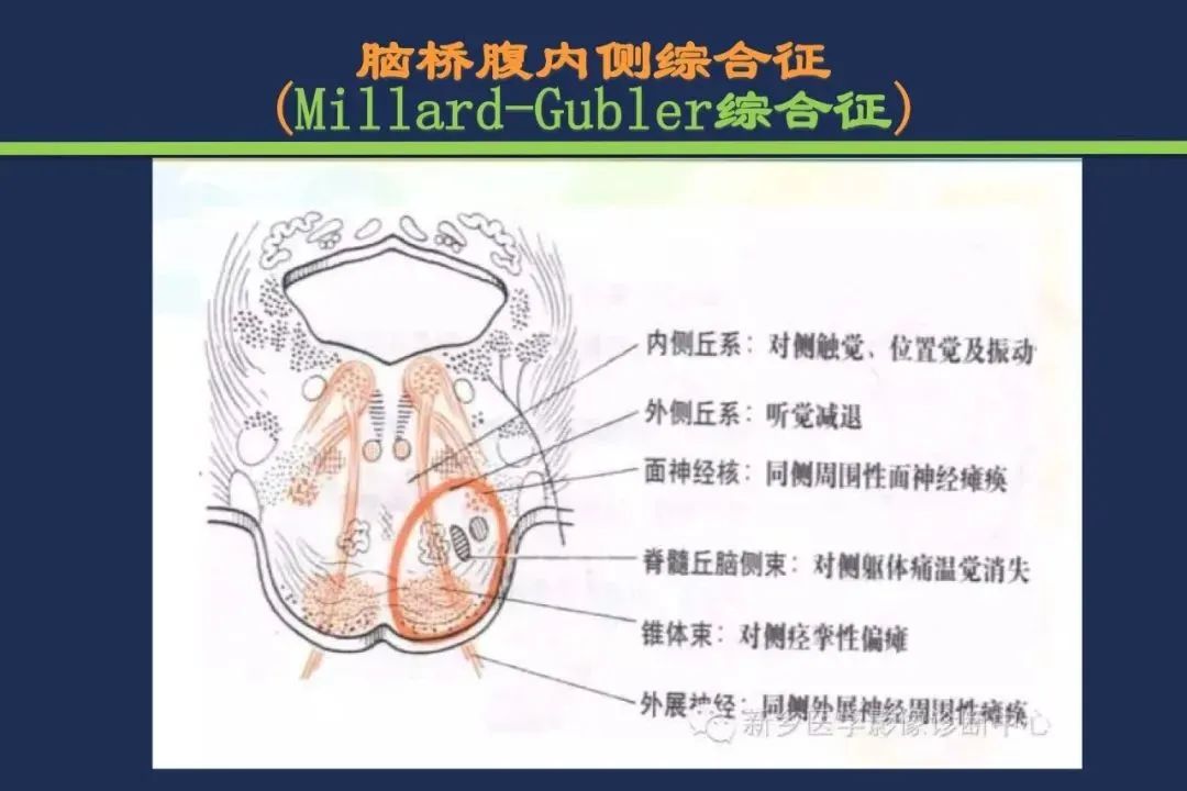 从梗死部位推测责任血管：脑血管解剖-139