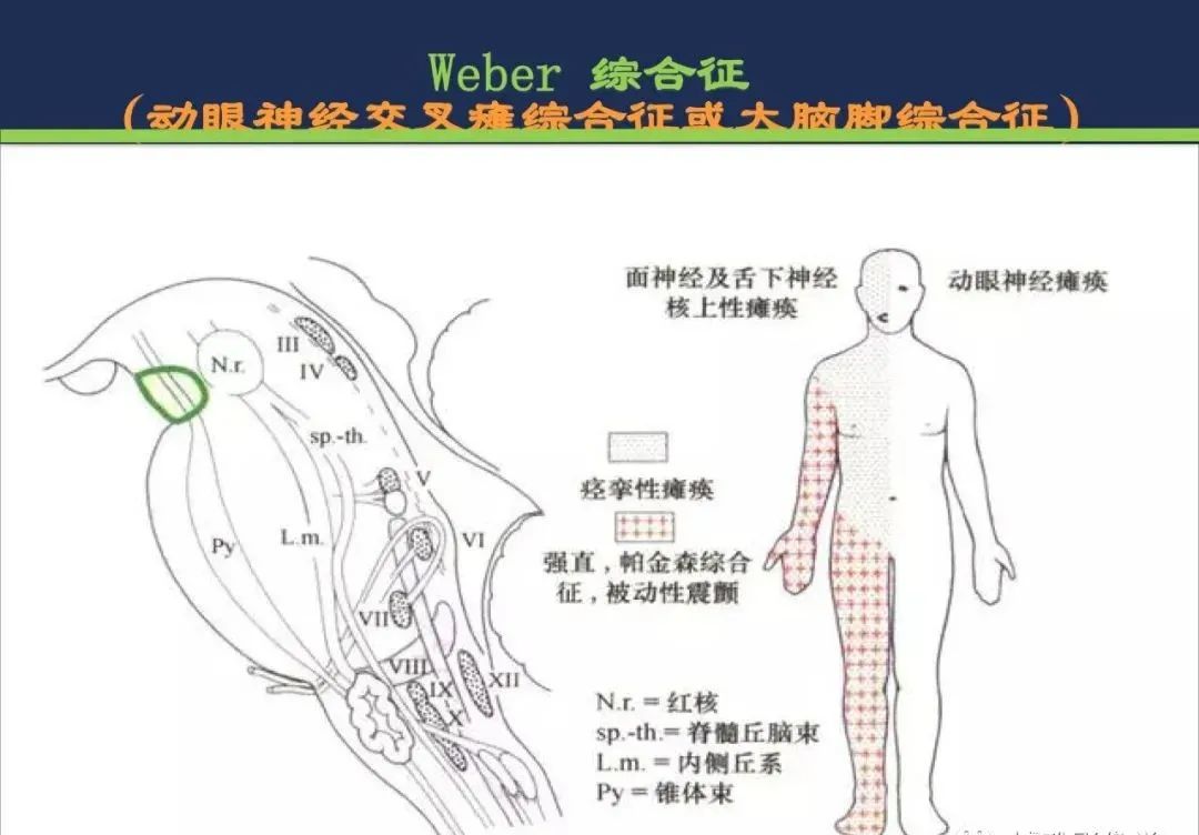 从梗死部位推测责任血管：脑血管解剖-149