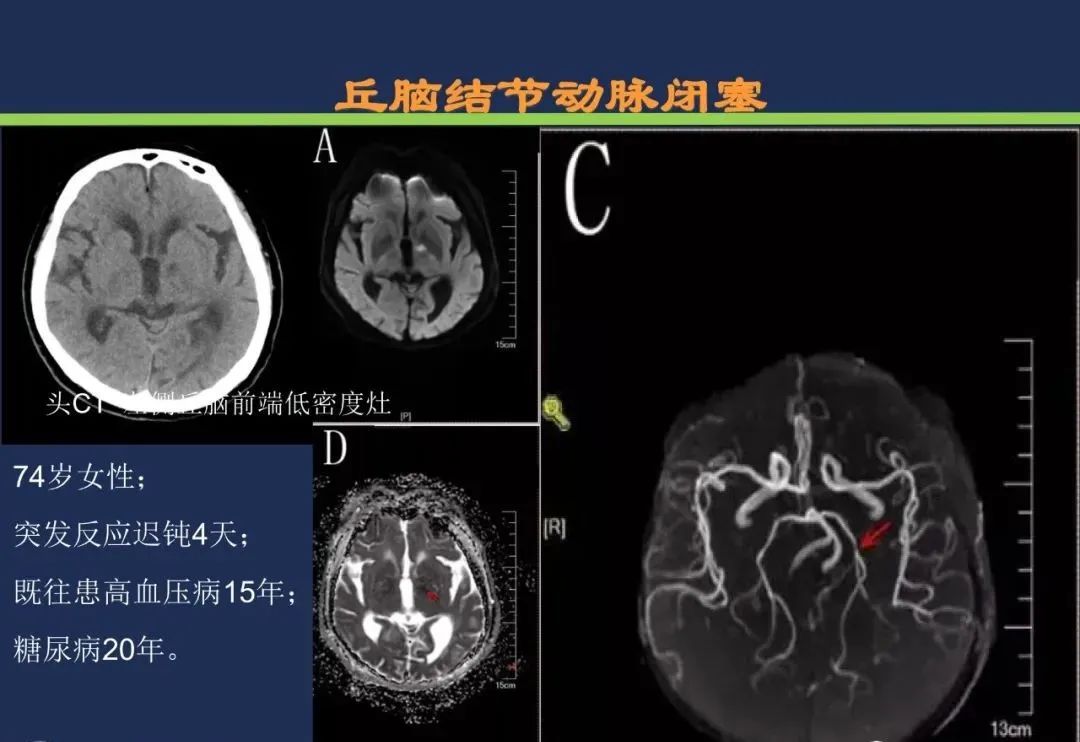 从梗死部位推测责任血管：脑血管解剖-119