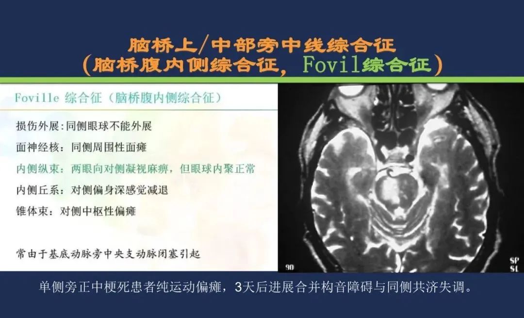 从梗死部位推测责任血管：脑血管解剖-133