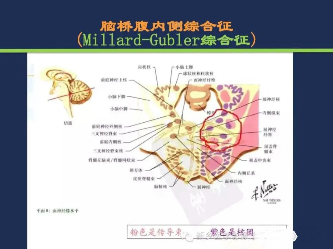 从梗死部位推测责任血管：脑血管解剖-138