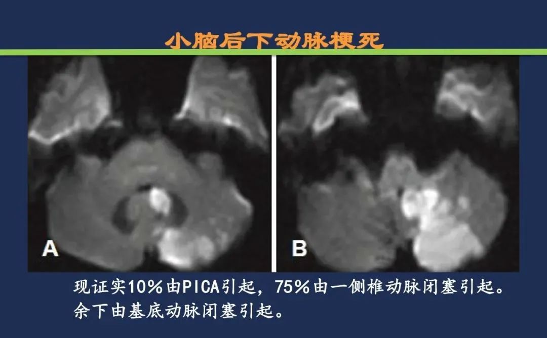 从梗死部位推测责任血管：脑血管解剖-175