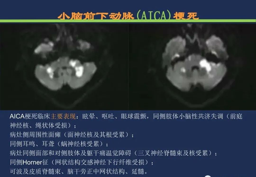从梗死部位推测责任血管：脑血管解剖-158