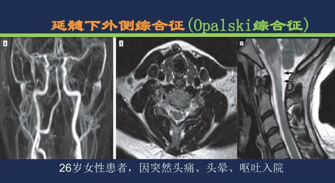 从梗死部位推测责任血管：脑血管解剖-177