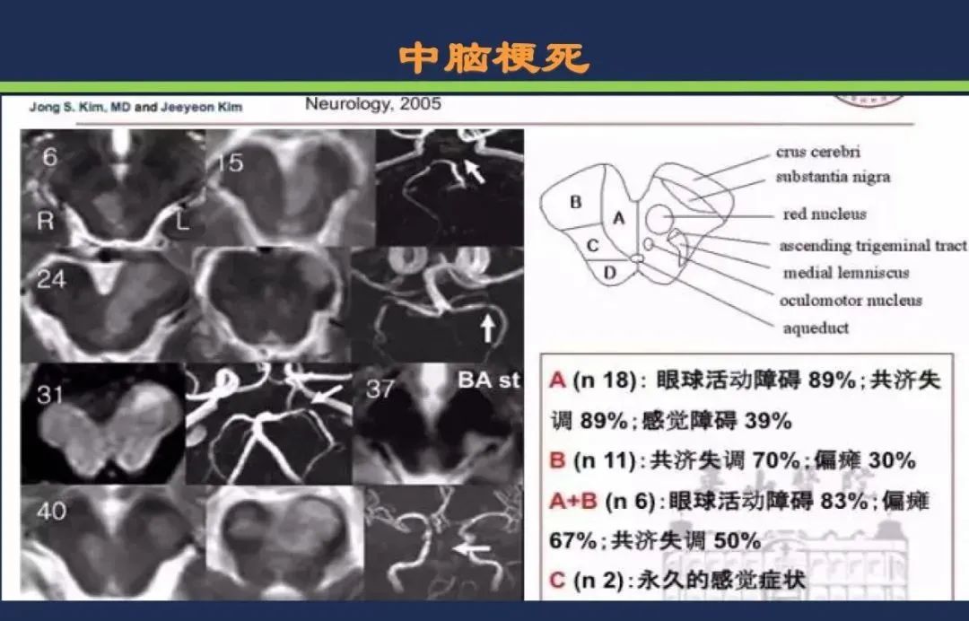 从梗死部位推测责任血管：脑血管解剖-155
