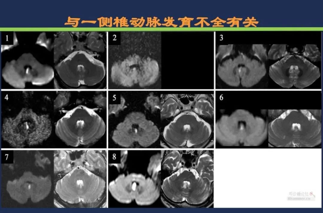 从梗死部位推测责任血管：脑血管解剖-174