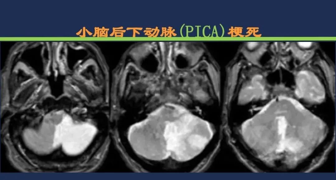 从梗死部位推测责任血管：脑血管解剖-168