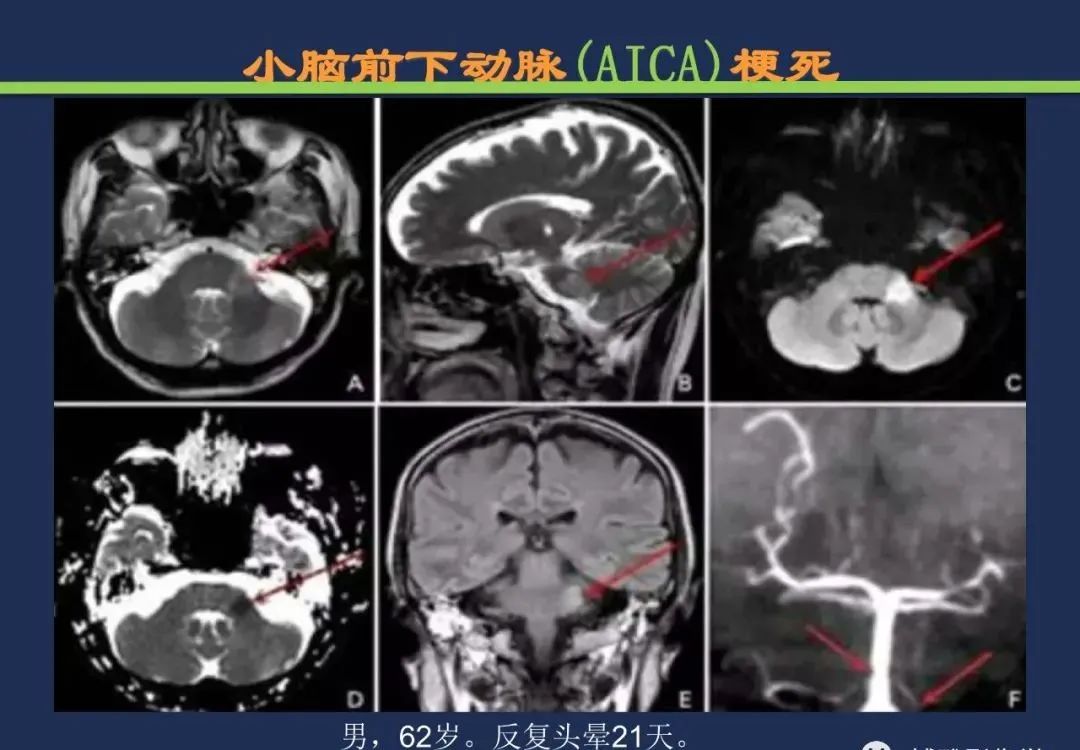从梗死部位推测责任血管：脑血管解剖-159