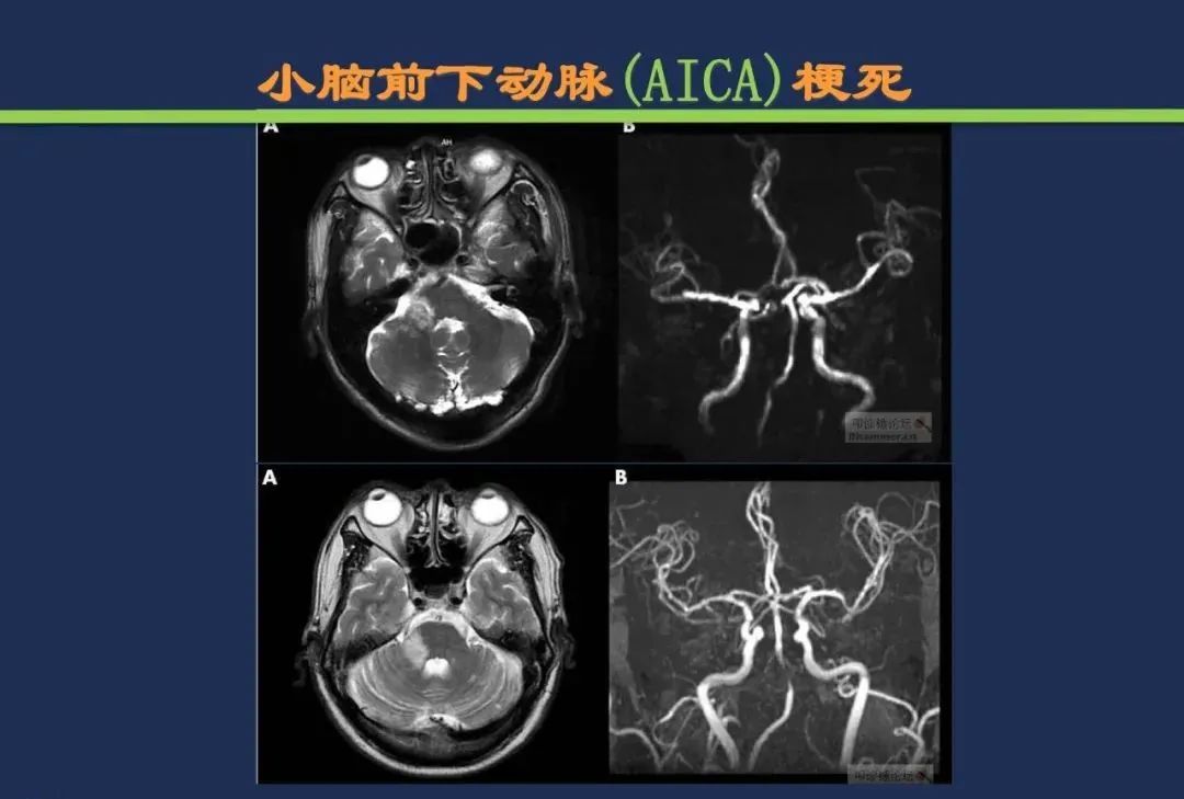 从梗死部位推测责任血管：脑血管解剖-160