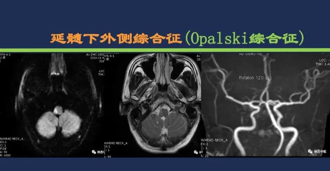 从梗死部位推测责任血管：脑血管解剖-179