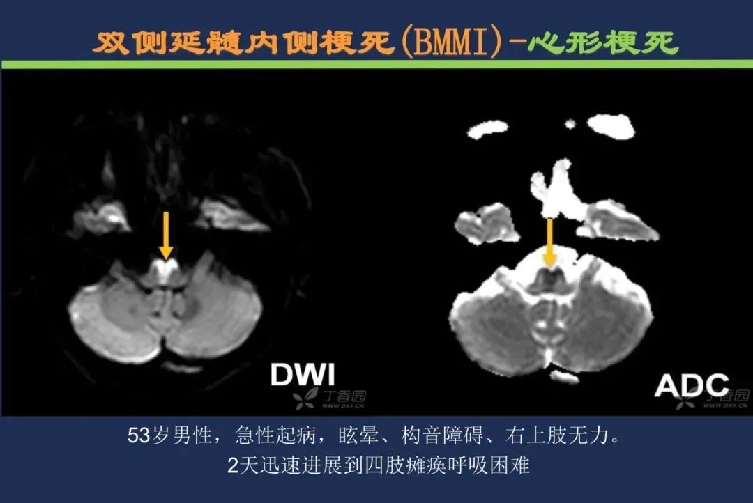 从梗死部位推测责任血管：脑血管解剖-193