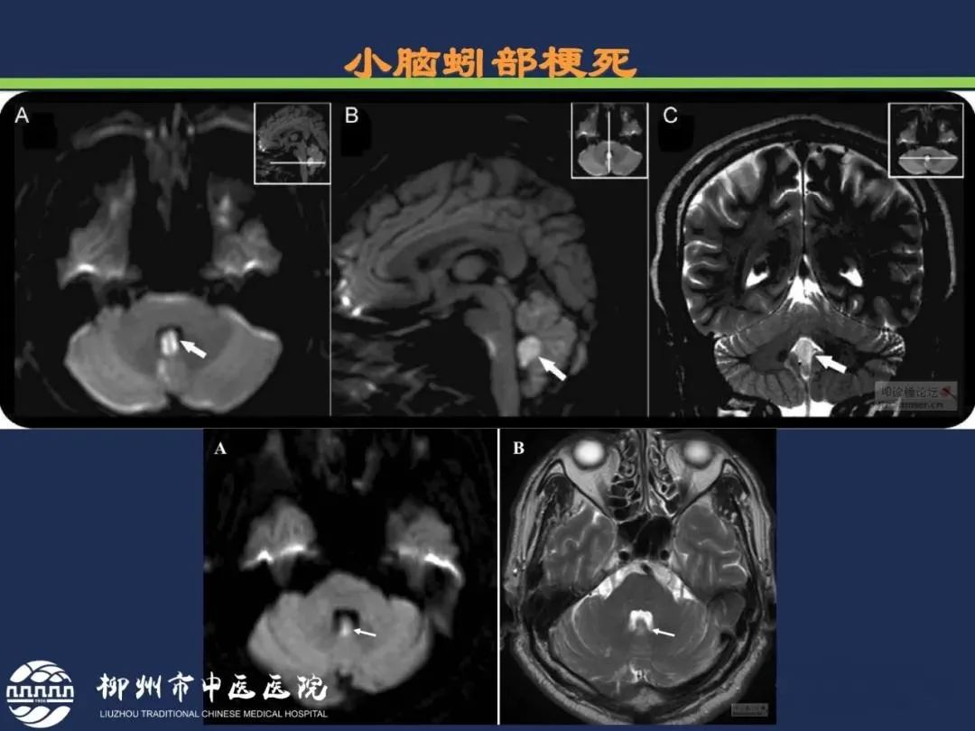 从梗死部位推测责任血管：脑血管解剖-173