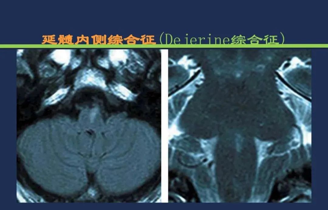 从梗死部位推测责任血管：脑血管解剖-188