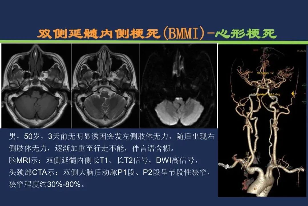 从梗死部位推测责任血管：脑血管解剖-197