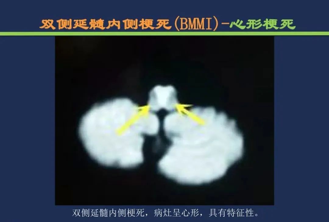 从梗死部位推测责任血管：脑血管解剖-192