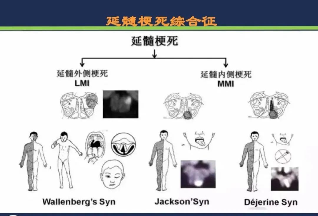 从梗死部位推测责任血管：脑血管解剖-183