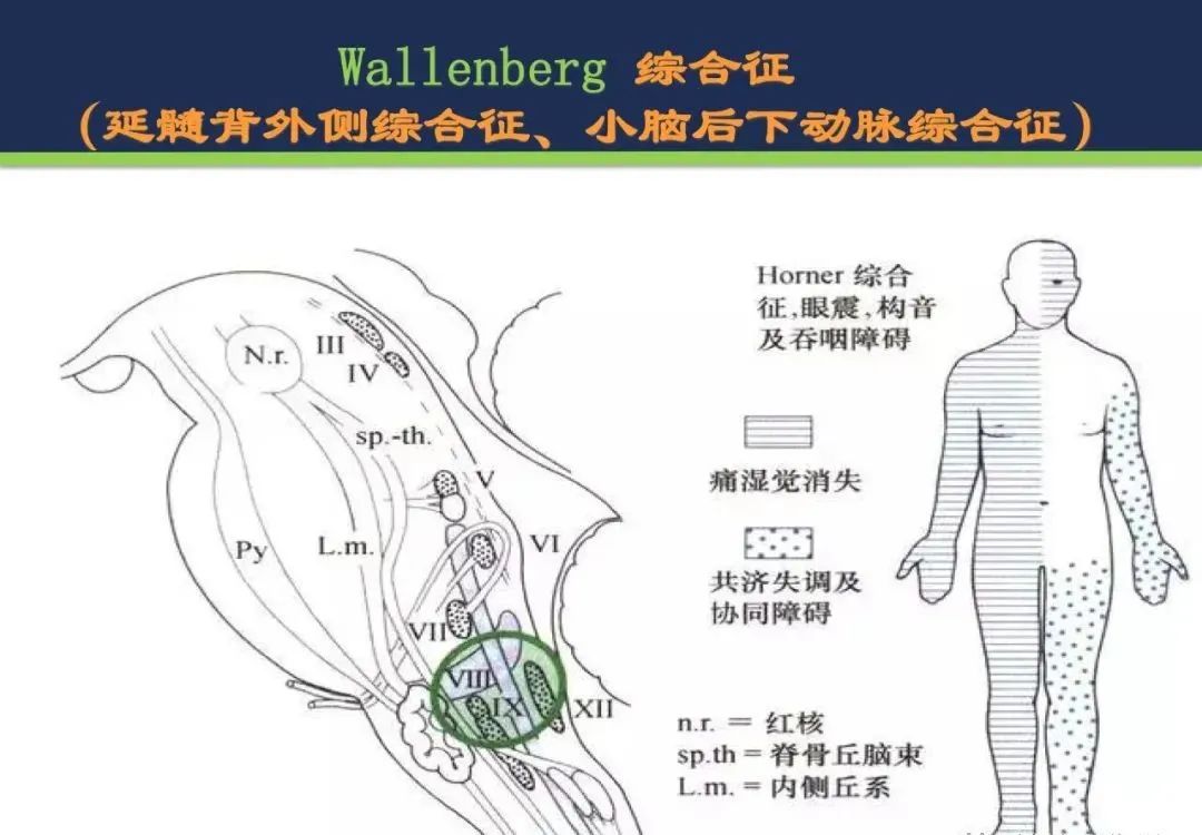 从梗死部位推测责任血管：脑血管解剖-163