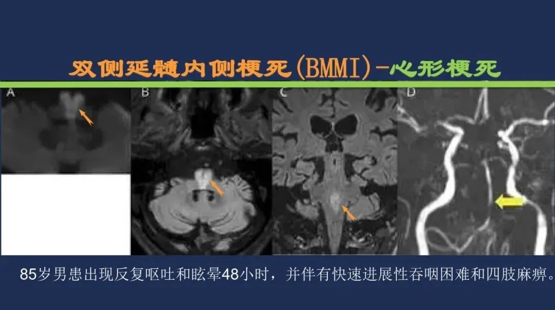 从梗死部位推测责任血管：脑血管解剖-194