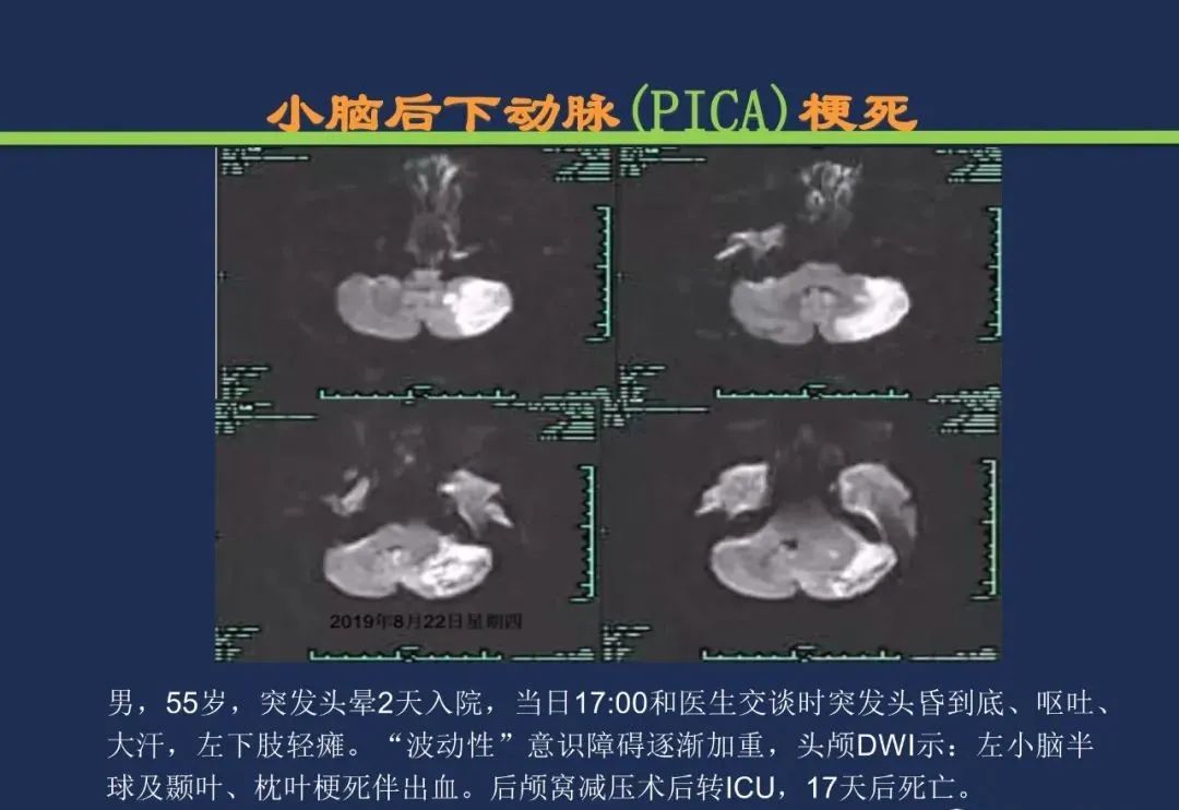 从梗死部位推测责任血管：脑血管解剖-169