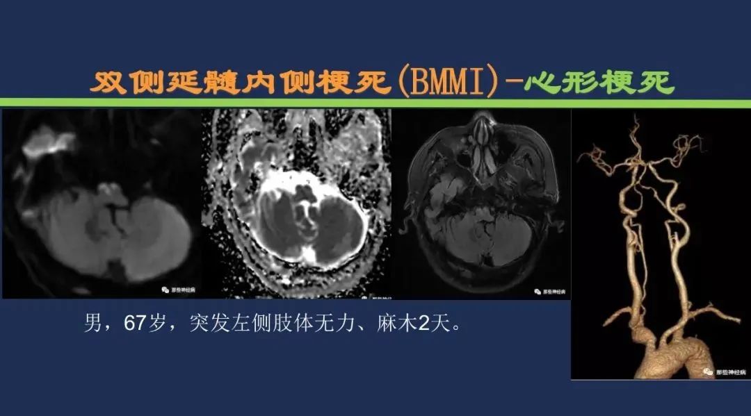 从梗死部位推测责任血管：脑血管解剖-196