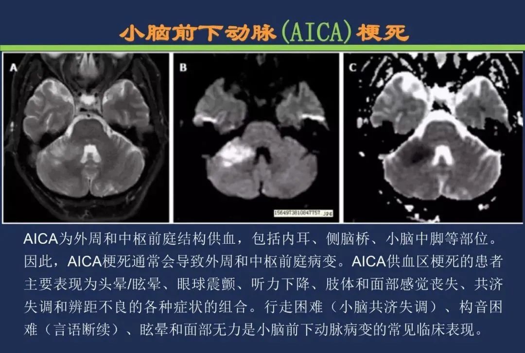 从梗死部位推测责任血管：脑血管解剖-156