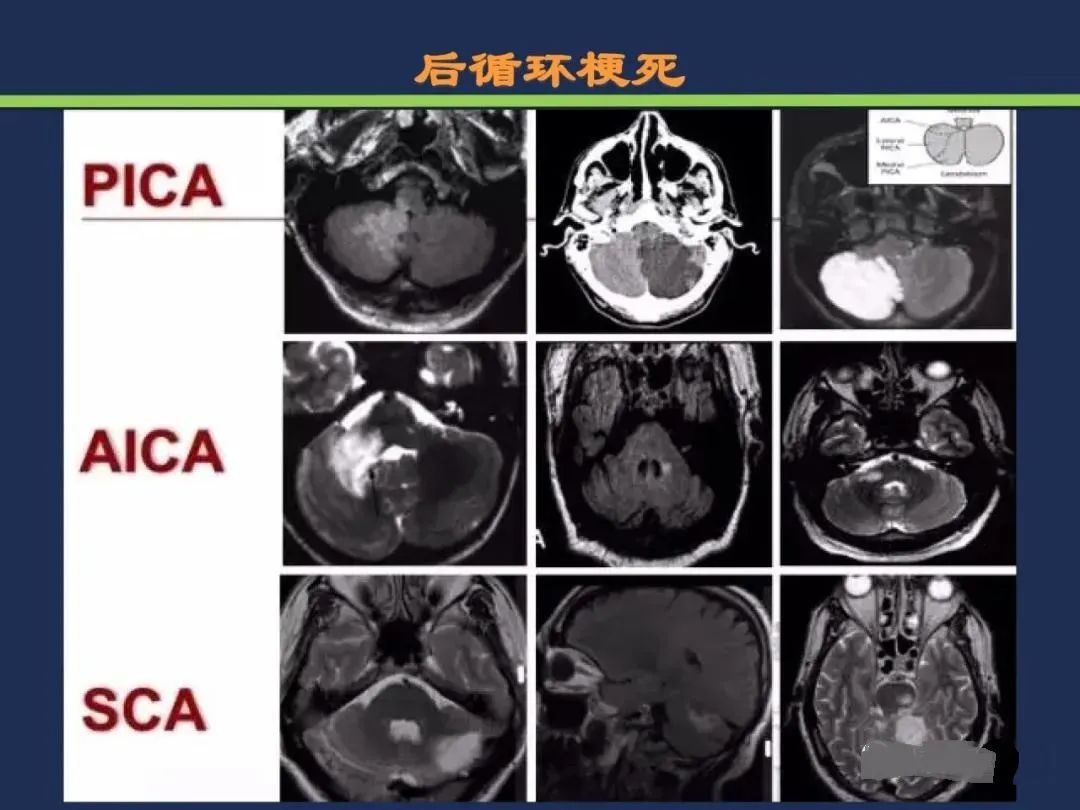 从梗死部位推测责任血管：脑血管解剖-154