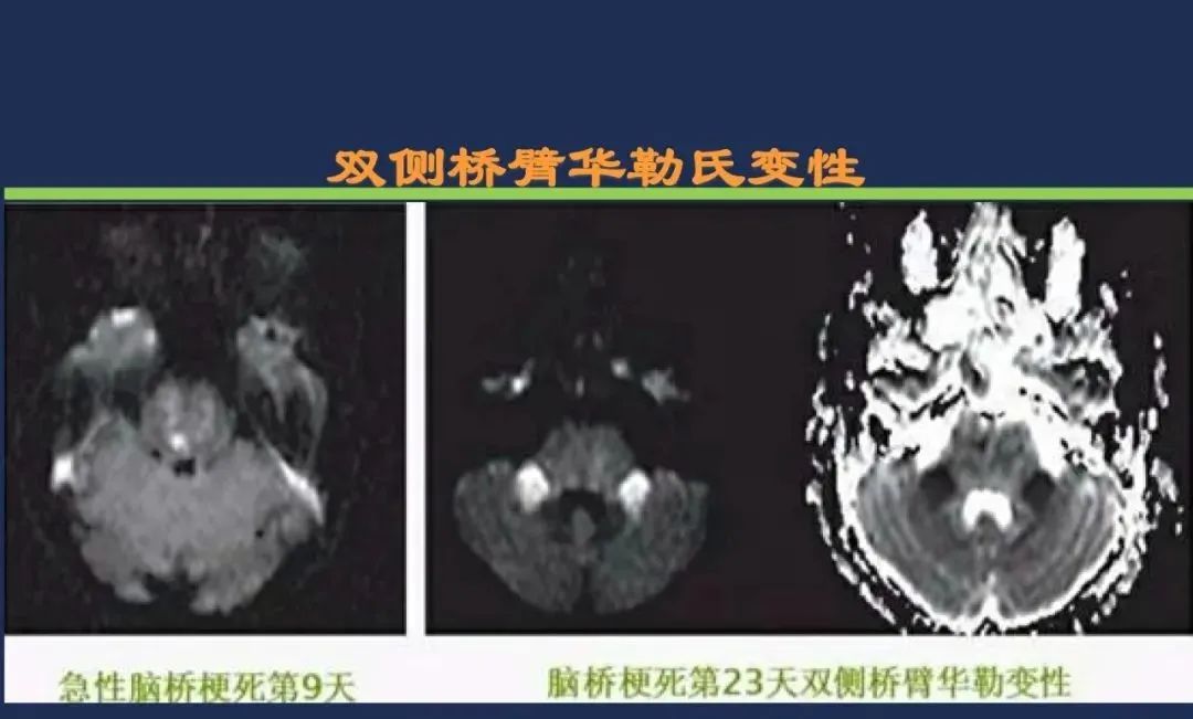 从梗死部位推测责任血管：脑血管解剖-162