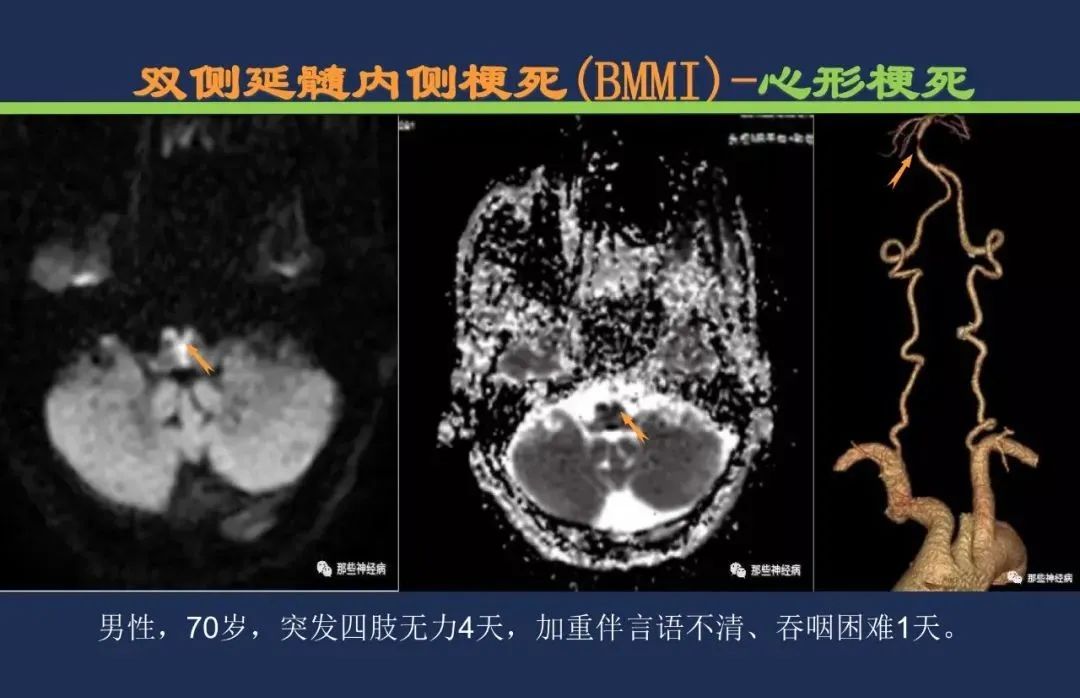 从梗死部位推测责任血管：脑血管解剖-195