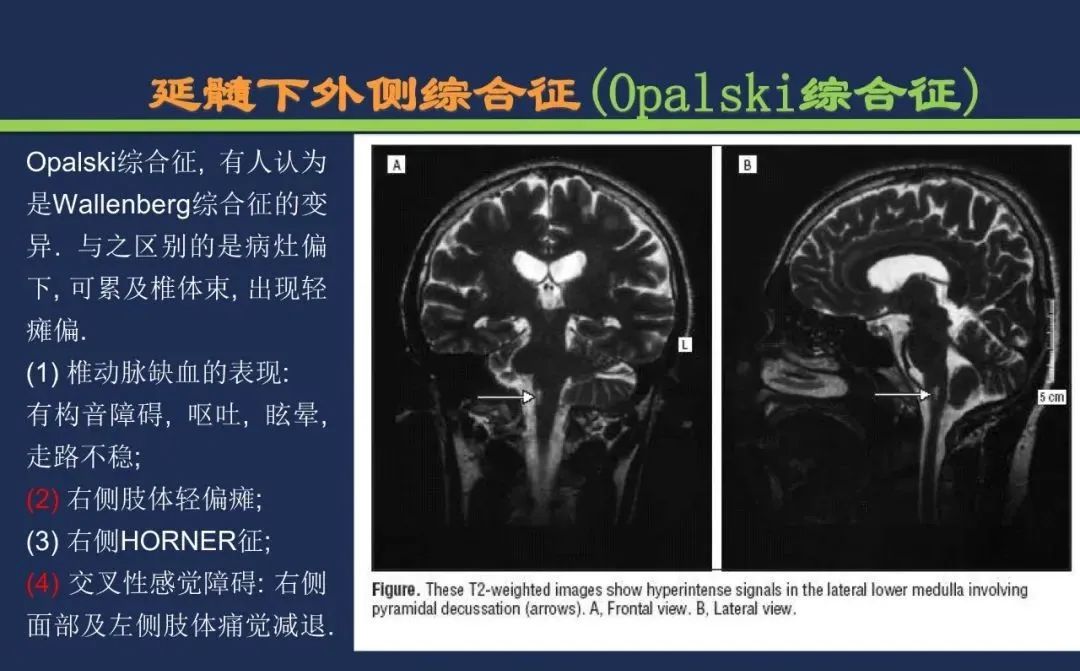 从梗死部位推测责任血管：脑血管解剖-176