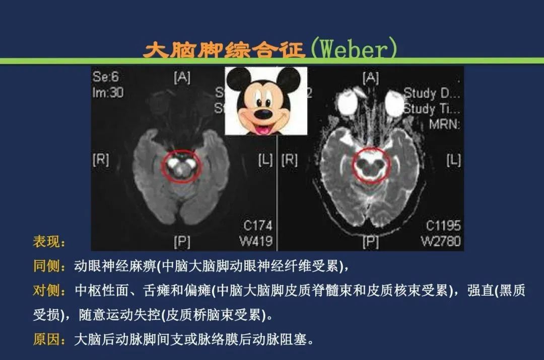 从梗死部位推测责任血管：脑血管解剖-150