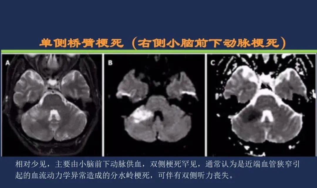 从梗死部位推测责任血管：脑血管解剖-157