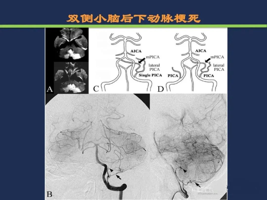 从梗死部位推测责任血管：脑血管解剖-172