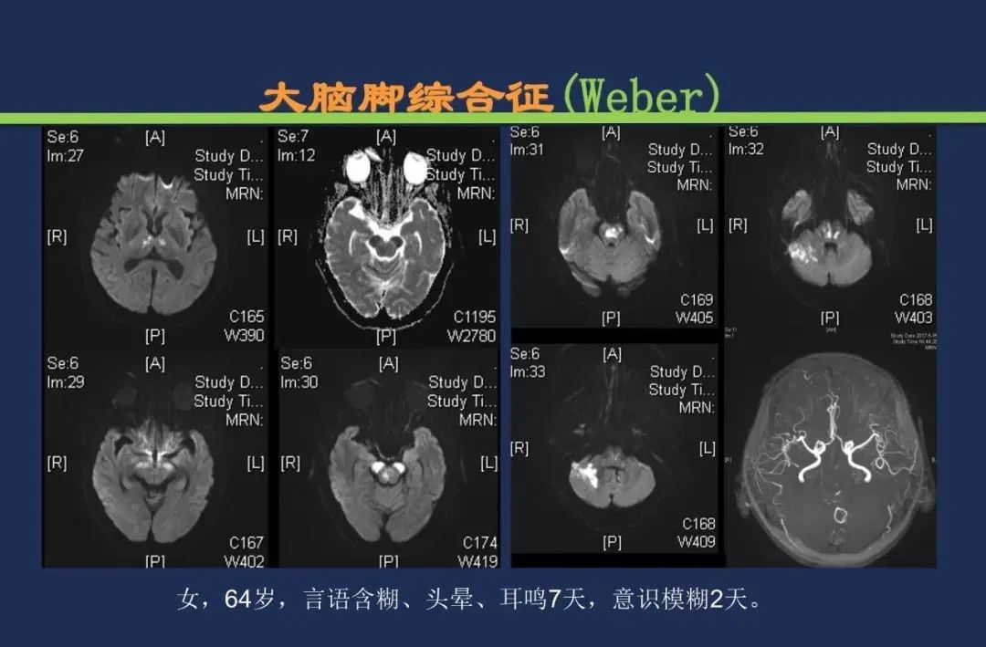 从梗死部位推测责任血管：脑血管解剖-152