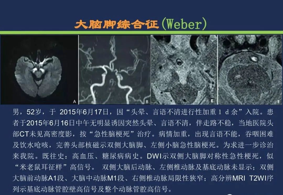 从梗死部位推测责任血管：脑血管解剖-151