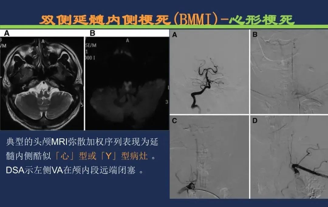 从梗死部位推测责任血管：脑血管解剖-198