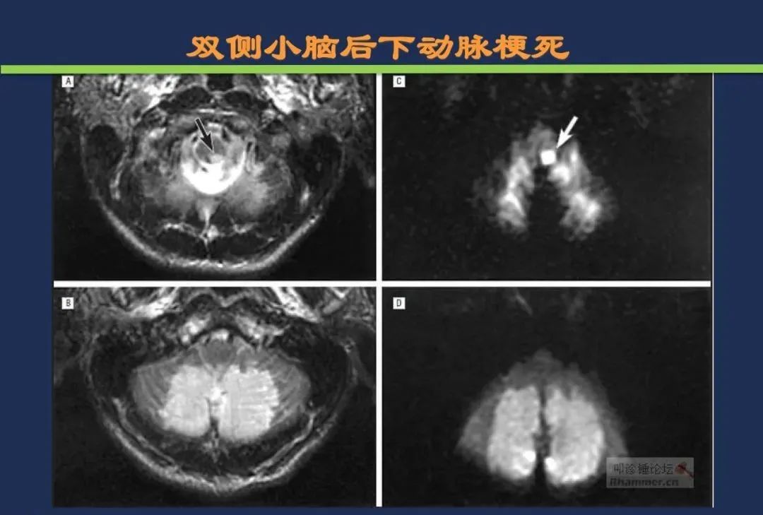从梗死部位推测责任血管：脑血管解剖-171