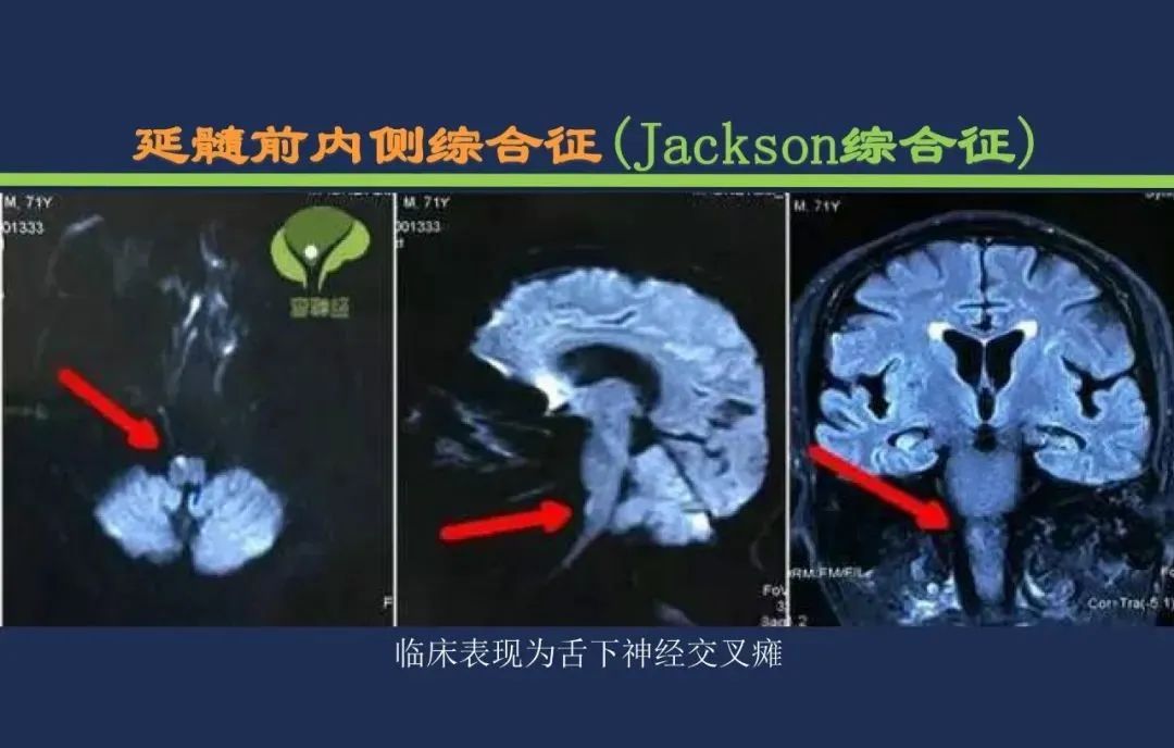 从梗死部位推测责任血管：脑血管解剖-190