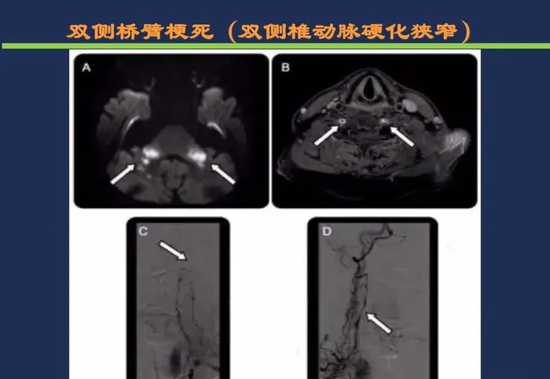 从梗死部位推测责任血管：脑血管解剖-161