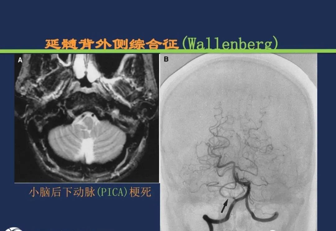 从梗死部位推测责任血管：脑血管解剖-165