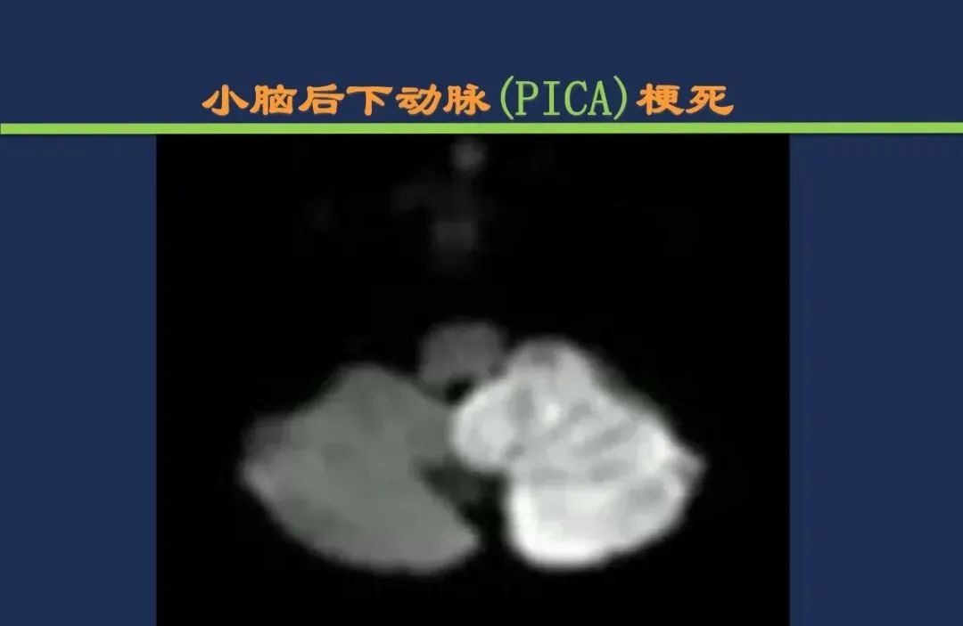 从梗死部位推测责任血管：脑血管解剖-170