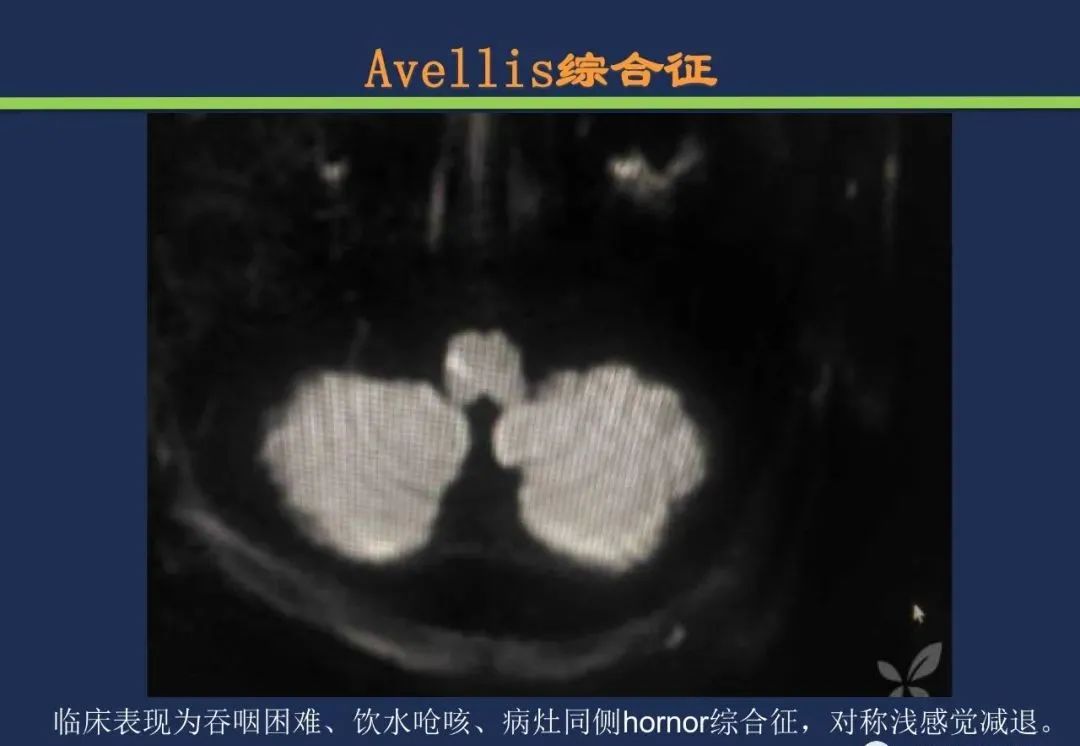 从梗死部位推测责任血管：脑血管解剖-191