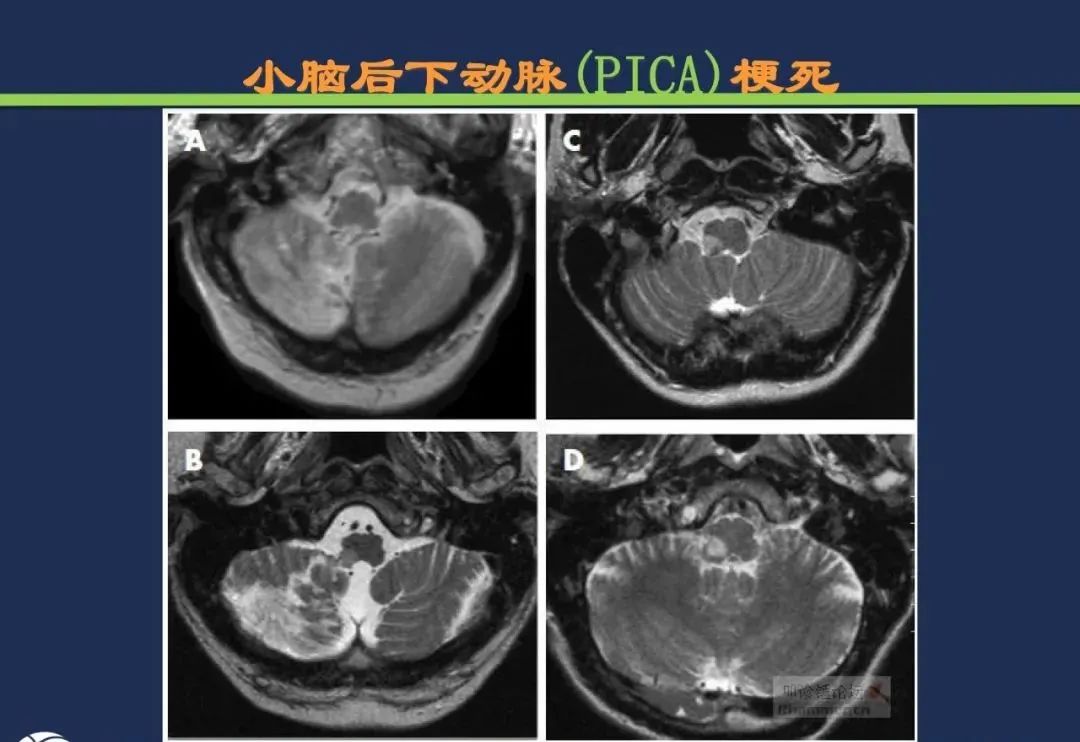 从梗死部位推测责任血管：脑血管解剖-167