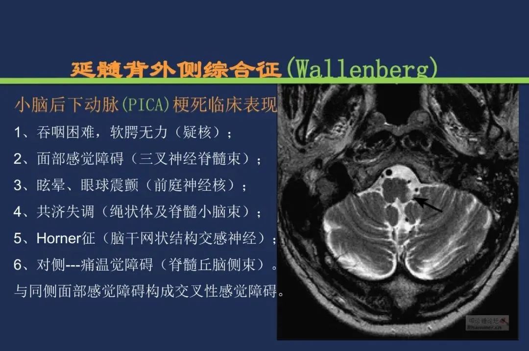 从梗死部位推测责任血管：脑血管解剖-164