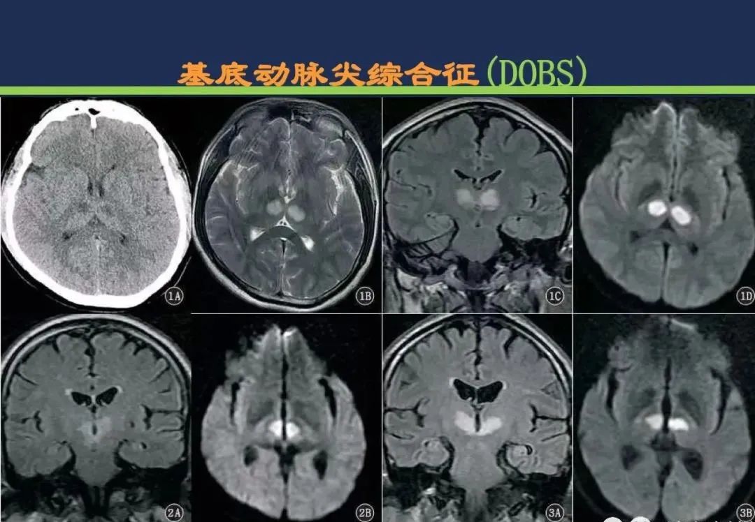 从梗死部位推测责任血管：脑血管解剖-207