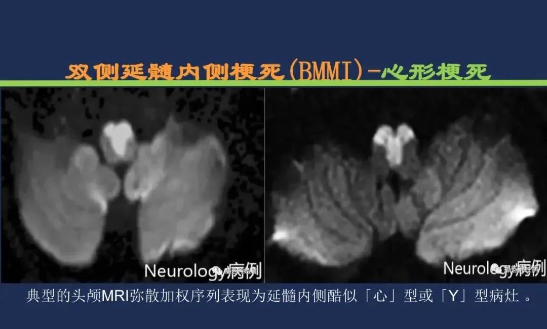 从梗死部位推测责任血管：脑血管解剖-200